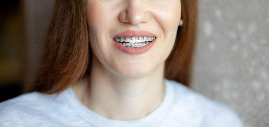 A smiling, attractive young woman with metal braces on her teeth