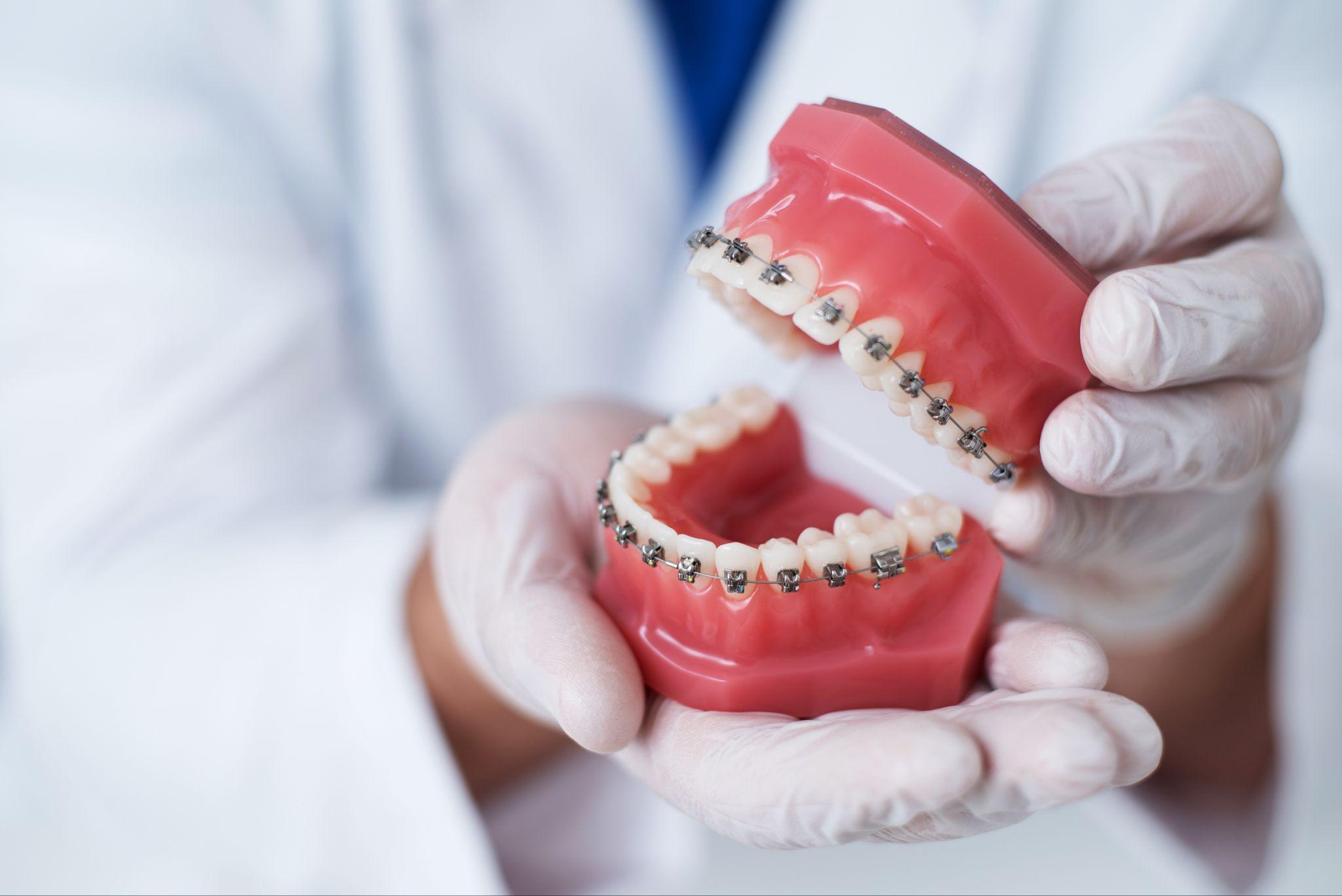 Orthodontist holding braces model